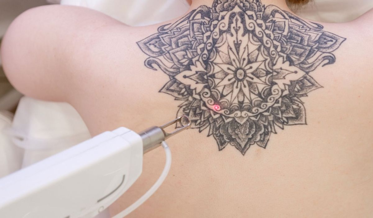 Quanto costa rimuovere un tatuaggio?